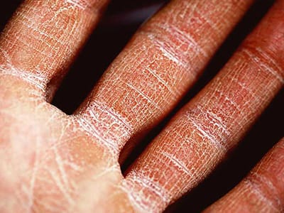 HVAC-dry-air-problems